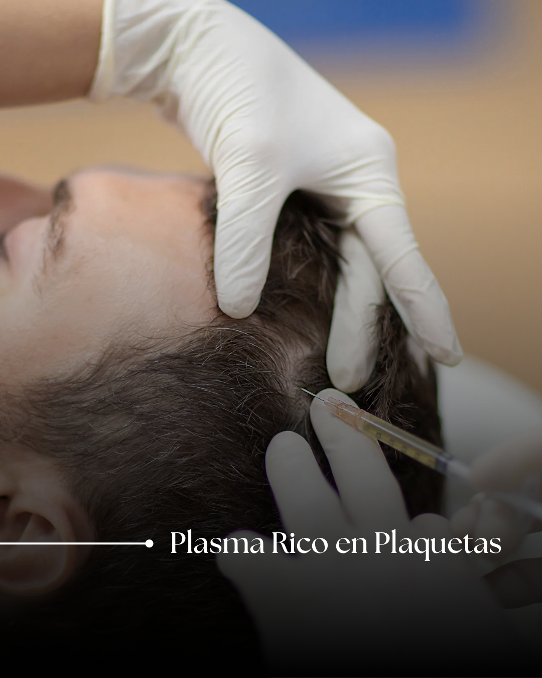 Plasma Rico en Plaquetas