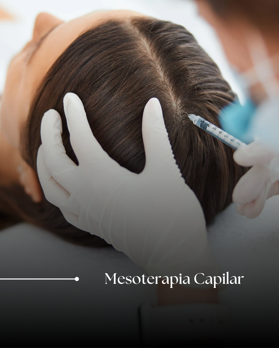 Mesoterapia Capilar