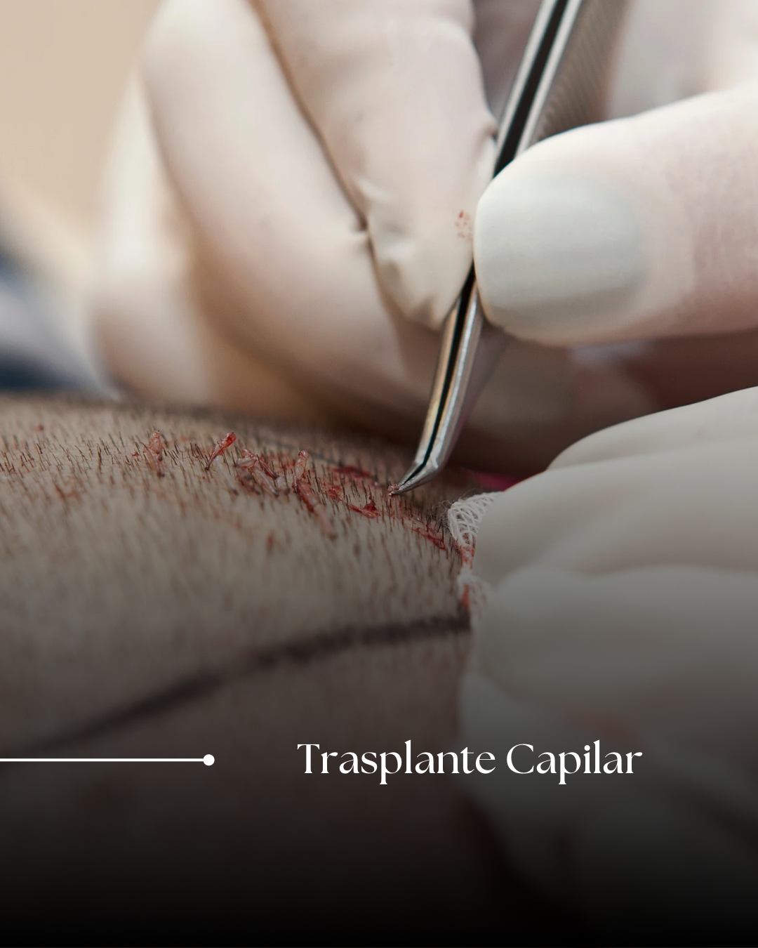 Implante Capilar